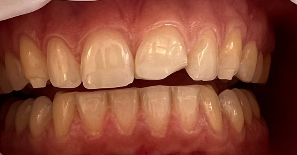 Comment reparer un angle de dent casse sans extraction ni facette featured